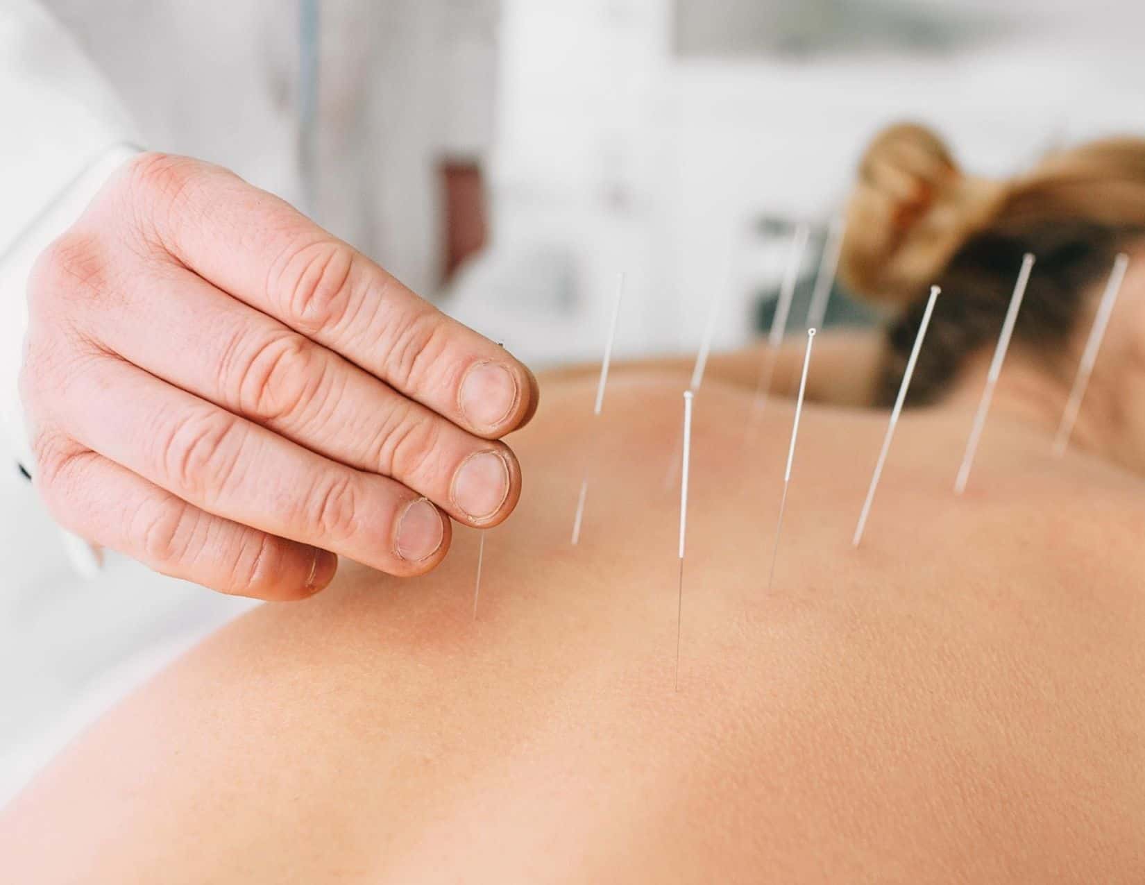 Acupuncture for Natural Allergy Relief